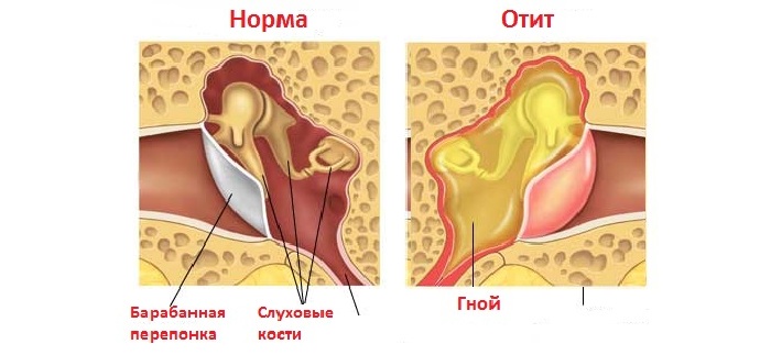 Гнойный отит