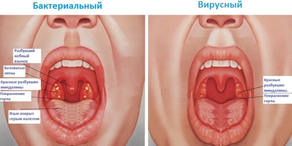 Хроническая болезнь горла