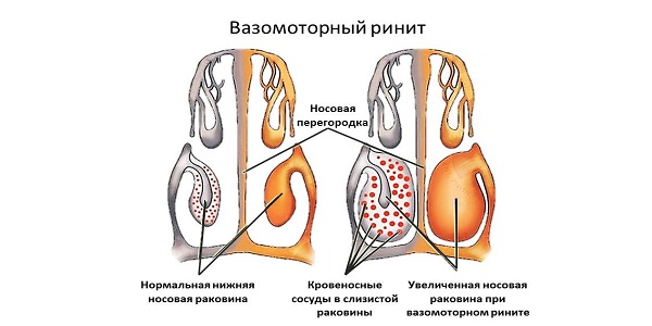 Вазомоторная форма