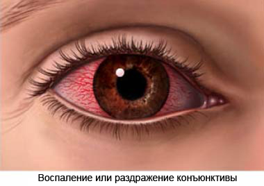 раздражение глаз