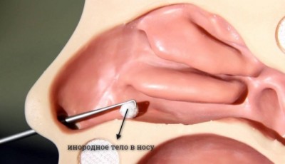 инородное тело в носу