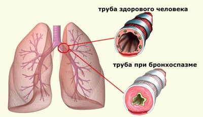 Труба при бронхоспазме