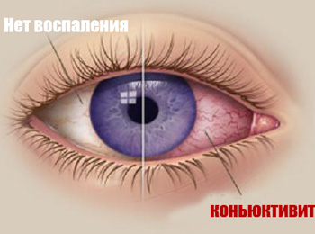 коньюктивит