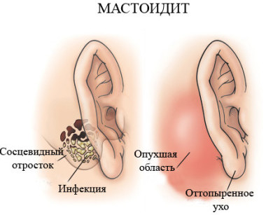 мастоидит