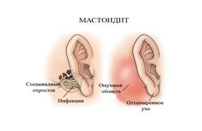Мастоидит