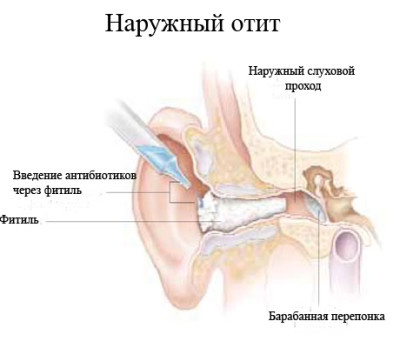 отит