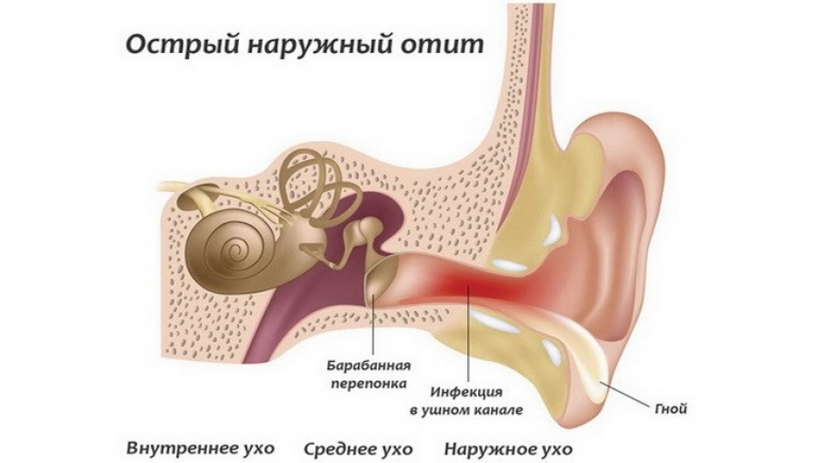 Наружный отит