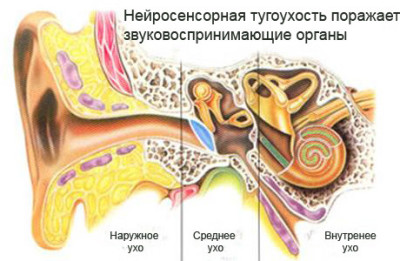 нейросенсорная тугоухость