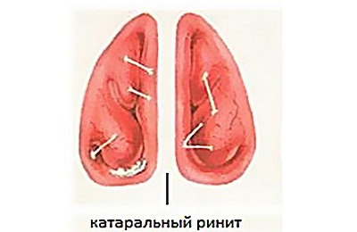Катаральная форма