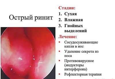 Острый ринит