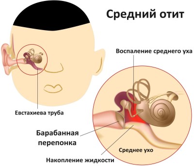 отит
