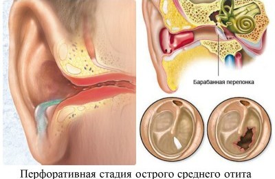 Отит