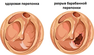 повреждение перепонки