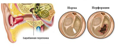 поражение барабанной перепонки