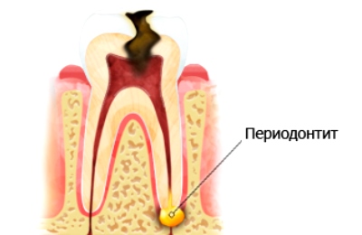 Периодонтит