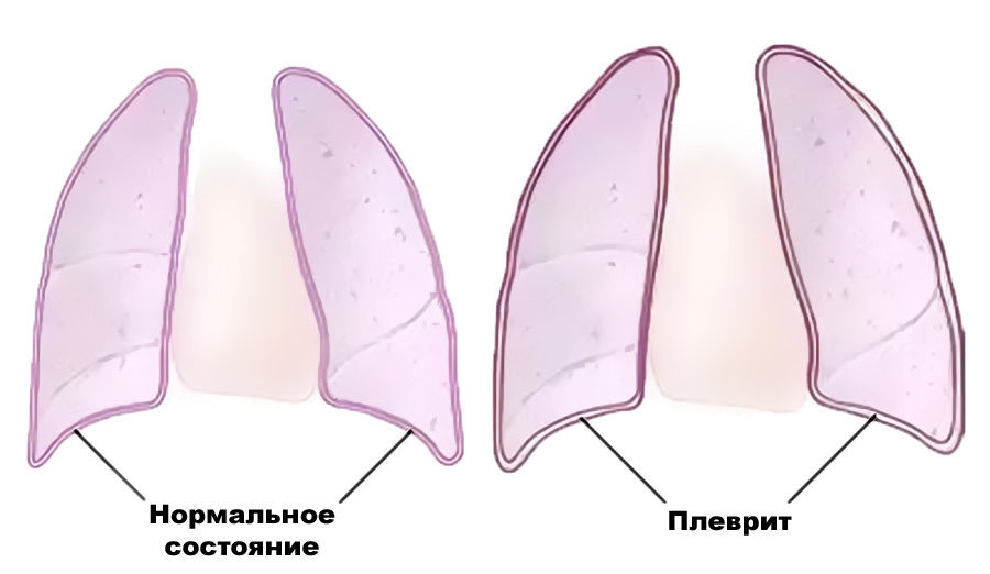 Плеврит
