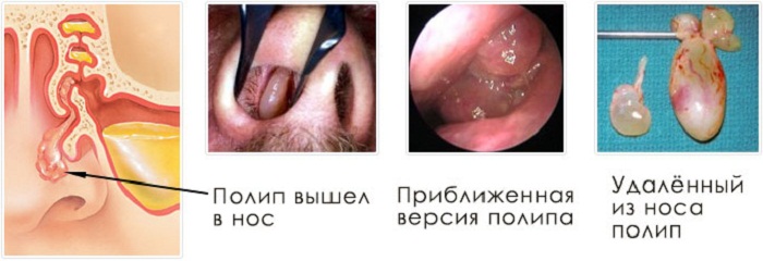 Полипы в носу