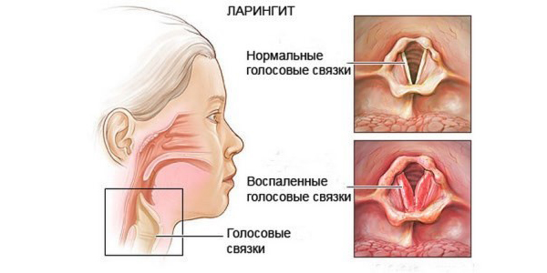 Поражение горла