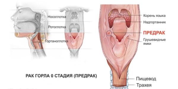 Предраковое состояние