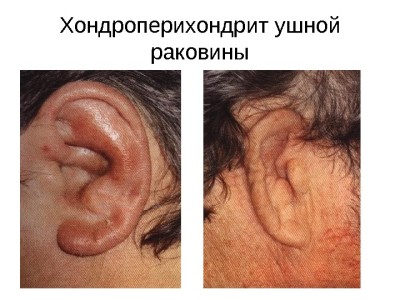Хондроперихондрит
