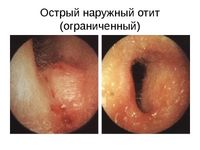 Ограниченный наружный отит
