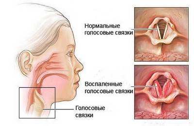 Проблемы с голосовыми связками