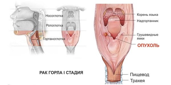 Рак горла