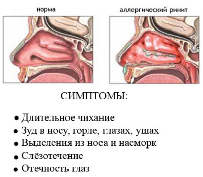 Ринит