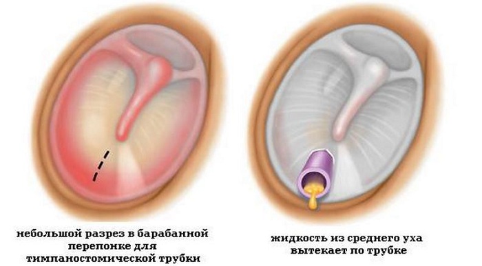 Установка шунта