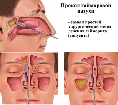 Прокол носовых пазух