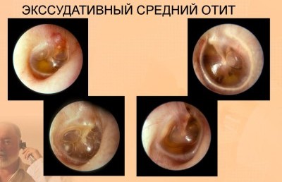 Экссудативный отит