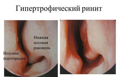 Гипертрофический ринит