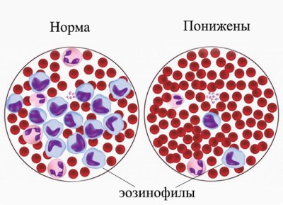 эозинофилы