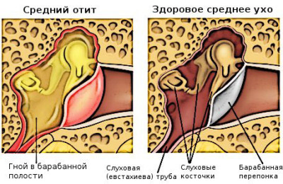 отит
