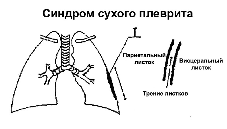 Сухой плеврит