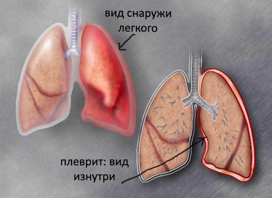 Плеврит