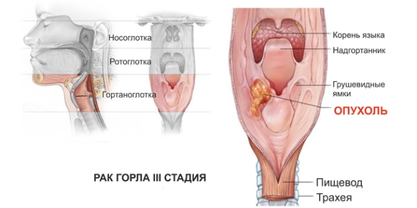 Третья стадия
