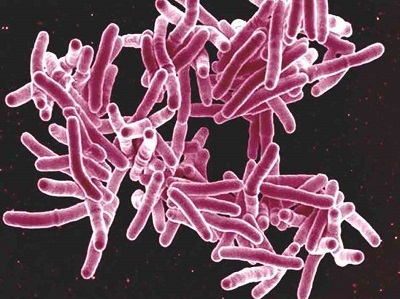 tuberculosis-2ce586815f5d8d3cd8eb89560dd5c3e26aa1834f-s6-c30
