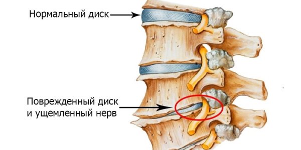 Ущемление нервных волокон