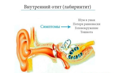 отит