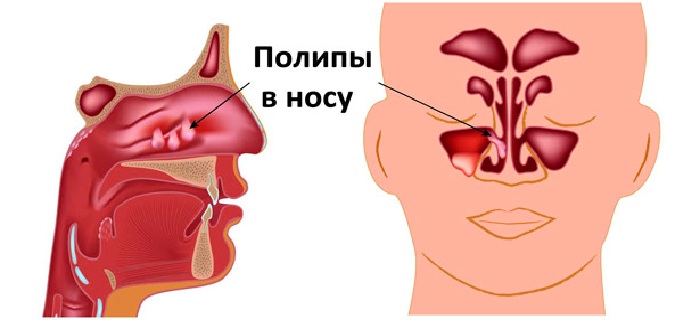Что такое полипы