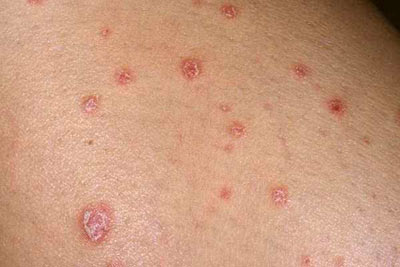 Чем лечить псориаз на теле chem-lechit-psoriaz-na-tele