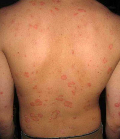 Чем лечить псориаз на теле в домашних условиях chem-lechit-psoriaz-na-tele-v-domashnih-usloviyah