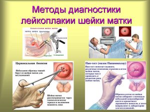 Диагностика лейкоплакии шейки матки diagnostika-lejkoplakii-shejki-matki