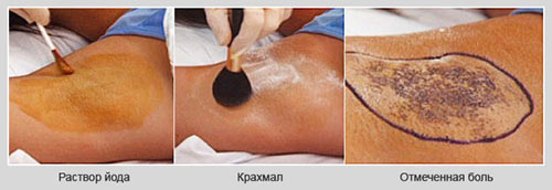 Диагностика повышенной потливости diagnostika-povyshennoj-potlivosti
