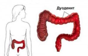 Лечение дуоденита медикаментами duodenit-lechenie