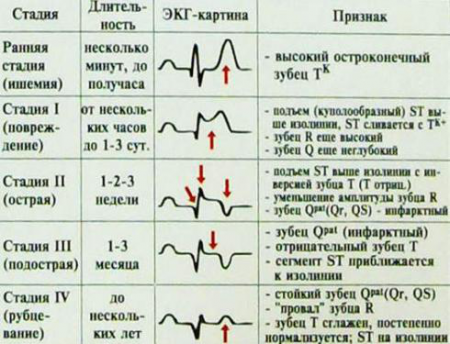 Изменения на электрокардиограмме при инфаркте Изменения на электрокардиограмме при инфаркте