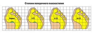 Как определить плоскостопие в домашних условиях kak-opredelit-ploskostopie-v-domashnih-usloviyah