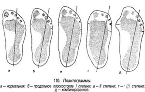 Как определить степень плоскостопия kak-opredelit-stepen-ploskostopiya