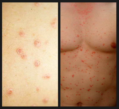 Как развивается псориаз первые симптомы kak-razvivaetsya-psoriaz-pervye-simptomy
